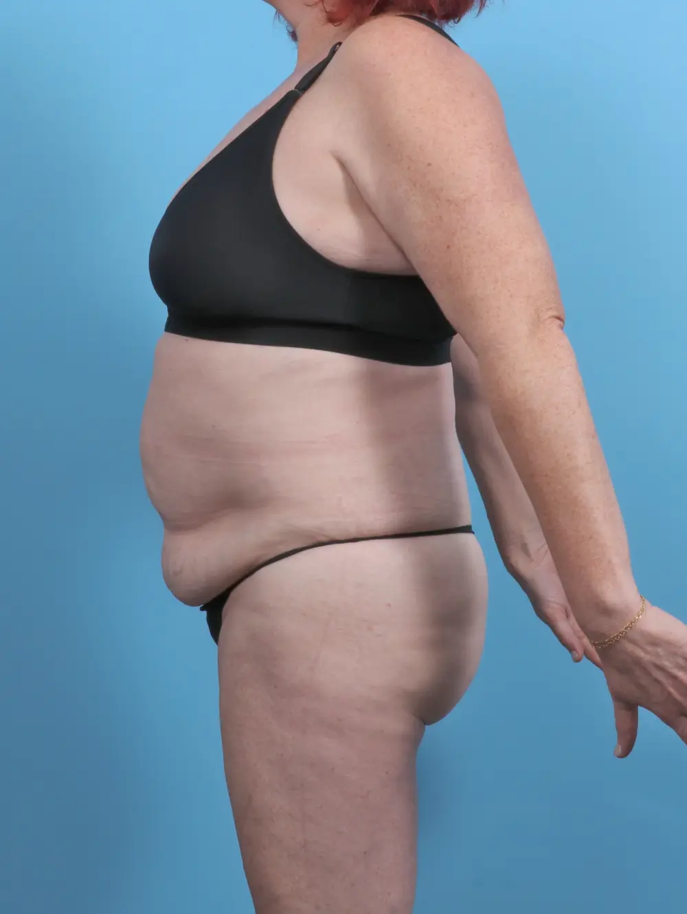 Tummy Tuck Patient Photo - Case 51119 - before view-2