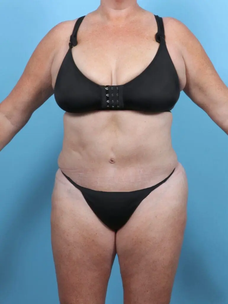 Tummy Tuck - Case 51119 - After