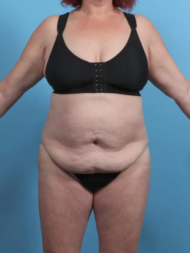 Tummy Tuck - Case 51119 - Before