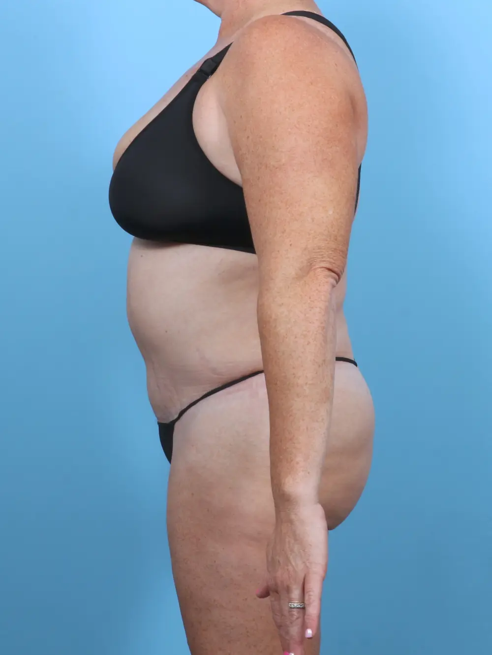 Tummy Tuck Patient Photo - Case 51119 - after view-2