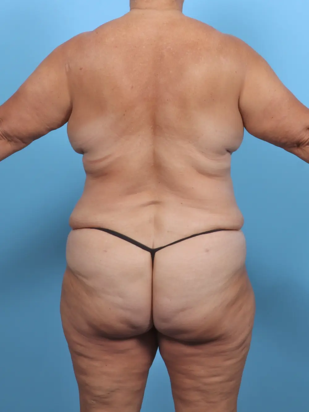 Tummy Tuck Patient Photo - Case 51129 - after view-3