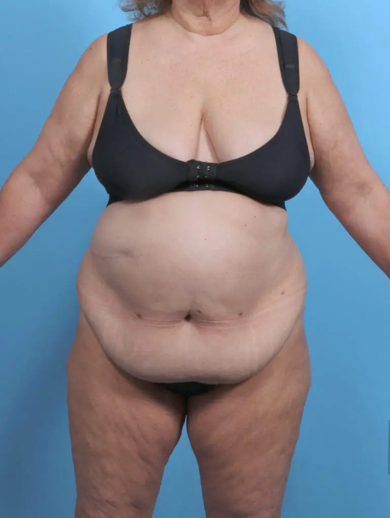 Tummy Tuck - Case 51129 - Before