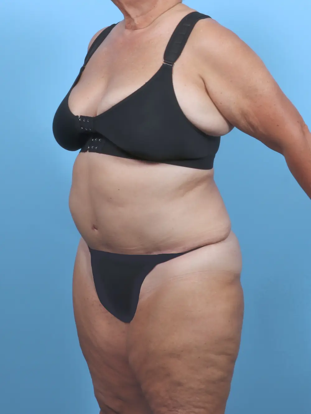 Tummy Tuck Patient Photo - Case 51129 - after view-1