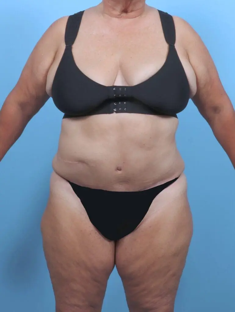 Tummy Tuck - Case 51129 - After