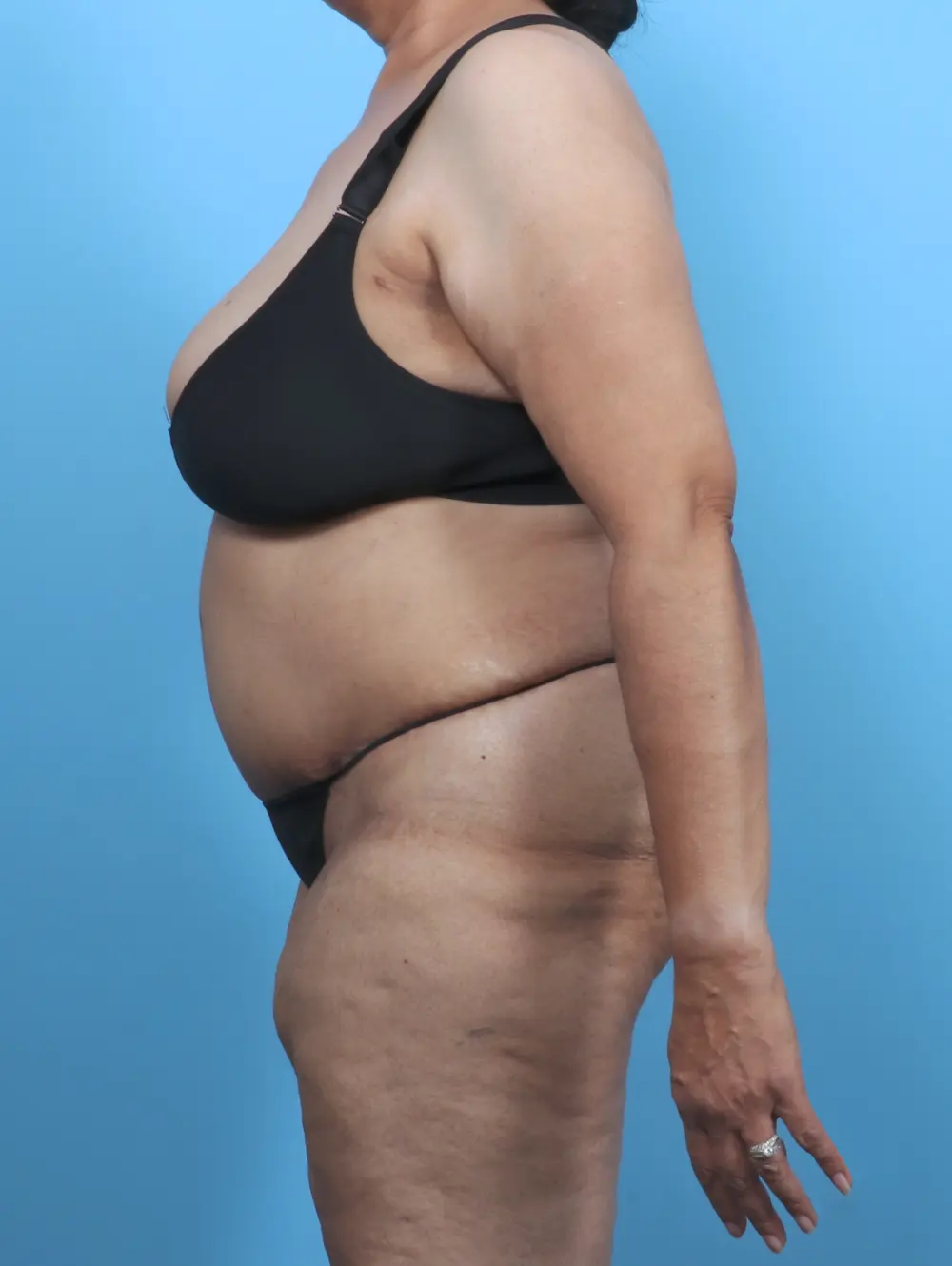 Tummy Tuck Patient Photo - Case 51160 - after view-2