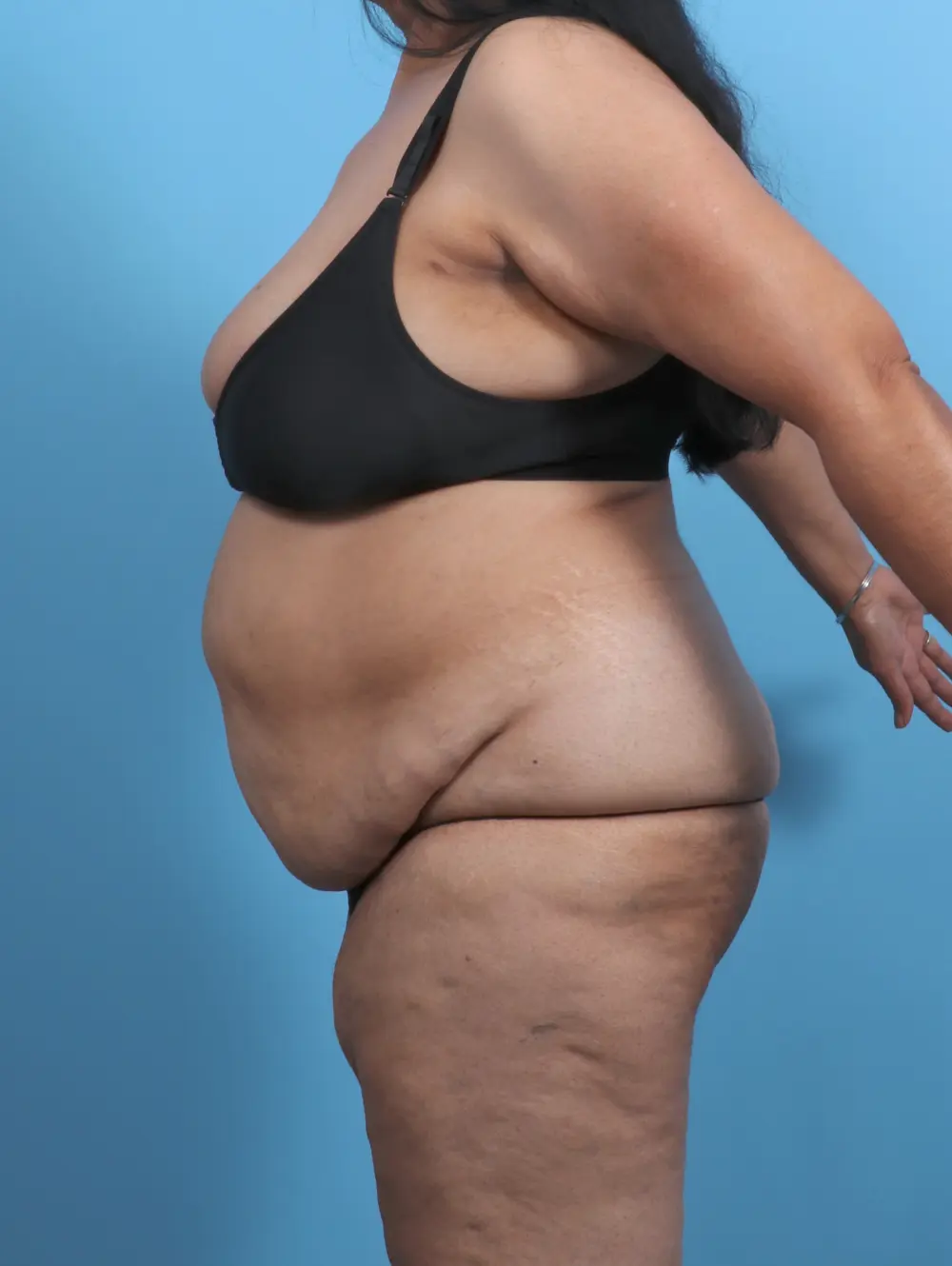 Tummy Tuck Patient Photo - Case 51160 - before view-2