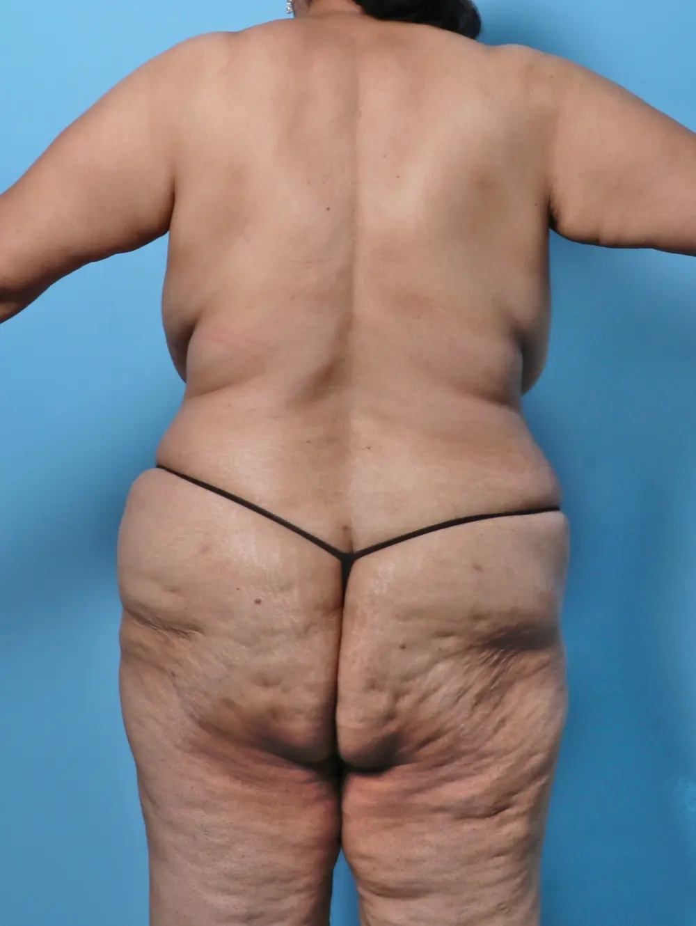 Tummy Tuck Patient Photo - Case 51160 - after view-3