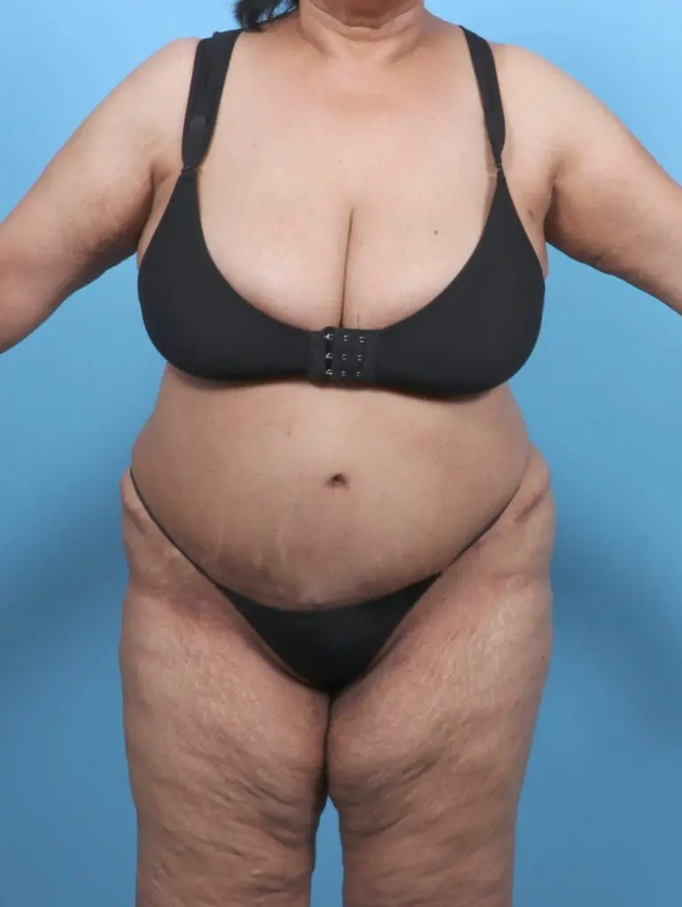 Tummy Tuck - Case 51160 - After