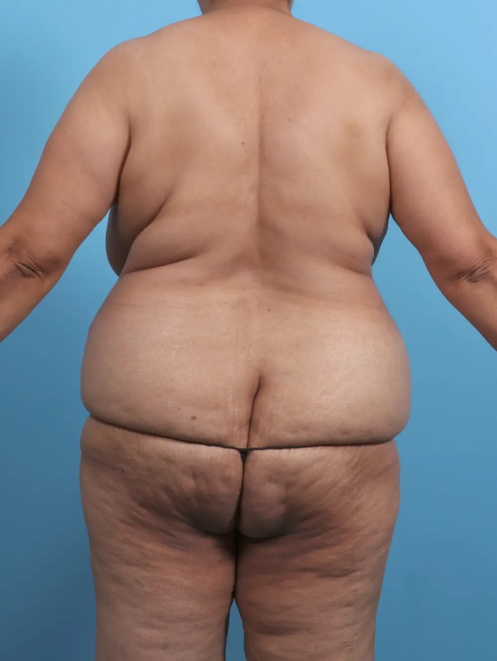 Tummy Tuck Patient Photo - Case 51160 - before view-3