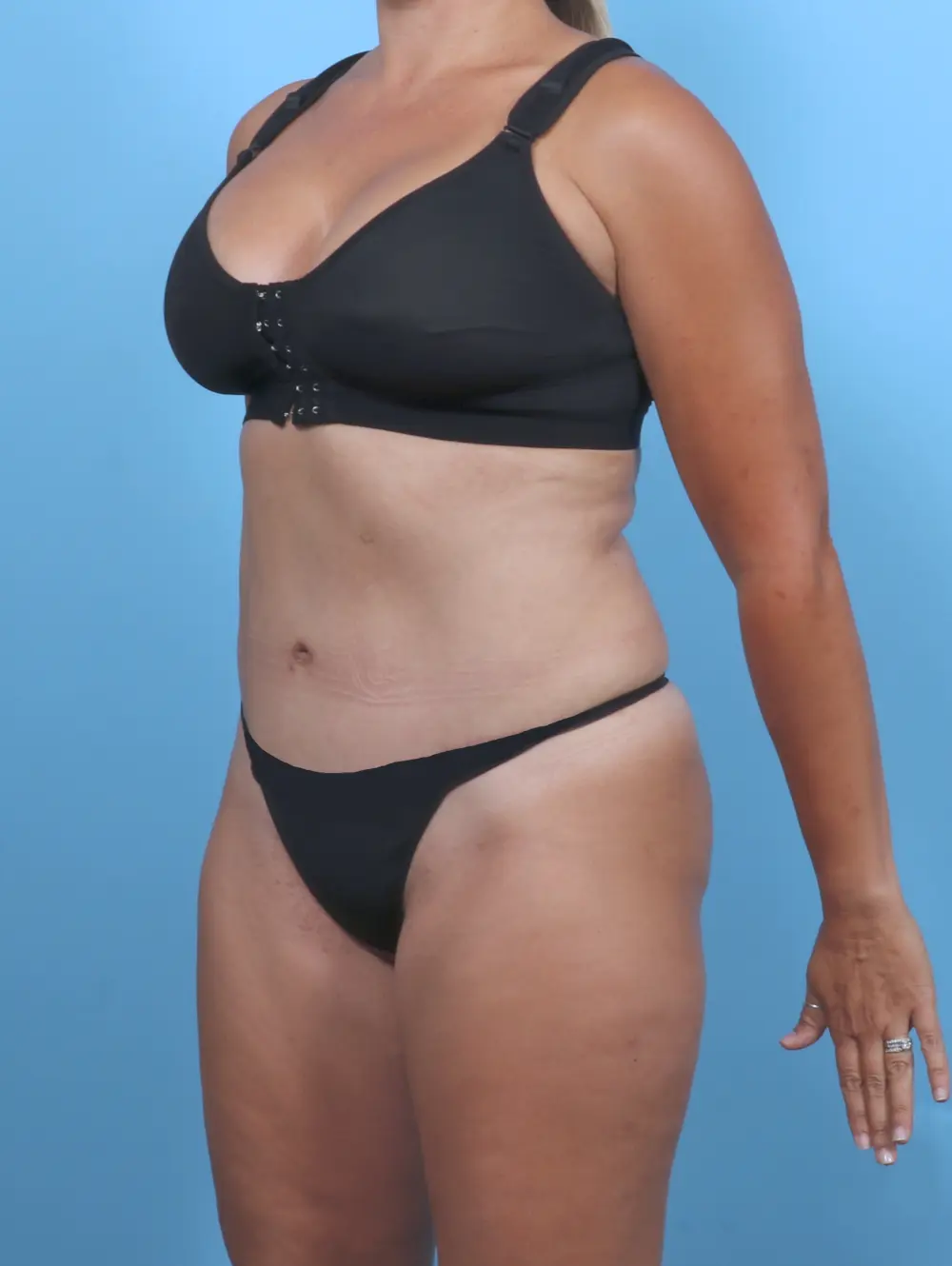 Tummy Tuck Patient Photo - Case 51178 - after view-1