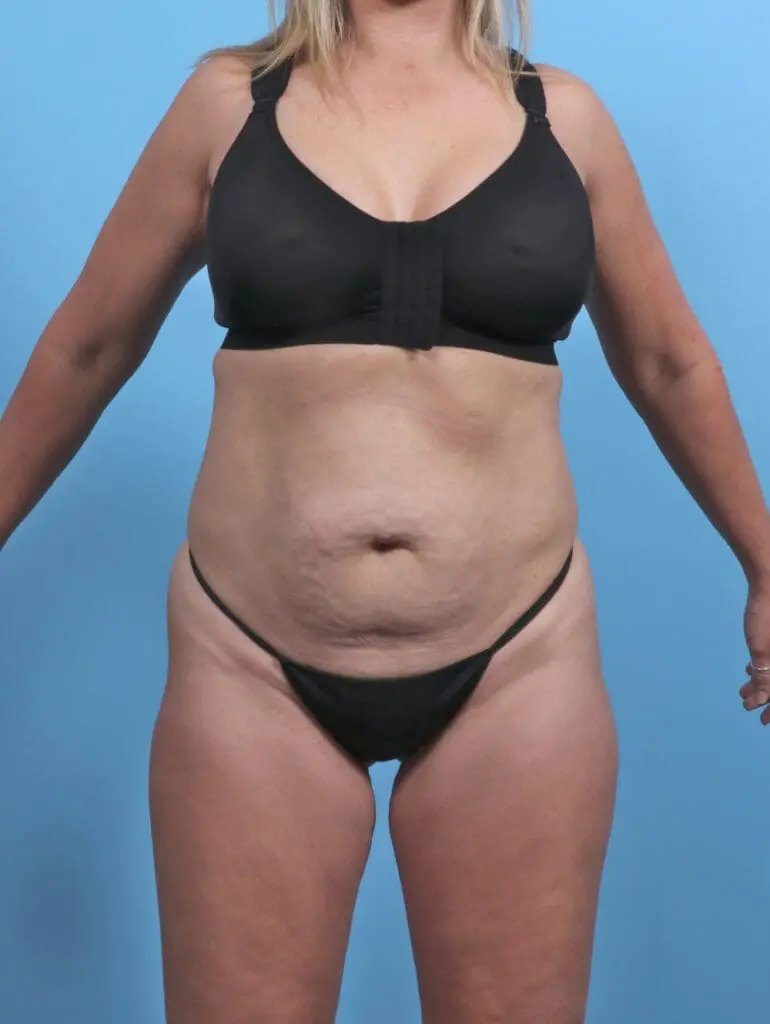 Tummy Tuck - Case 51178 - Before