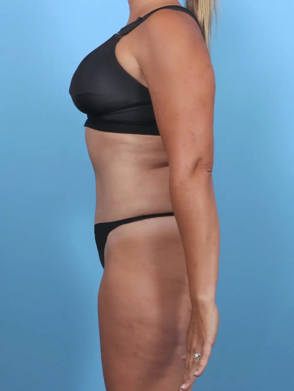 Tummy Tuck Patient Photo - Case 51178 - after view-2