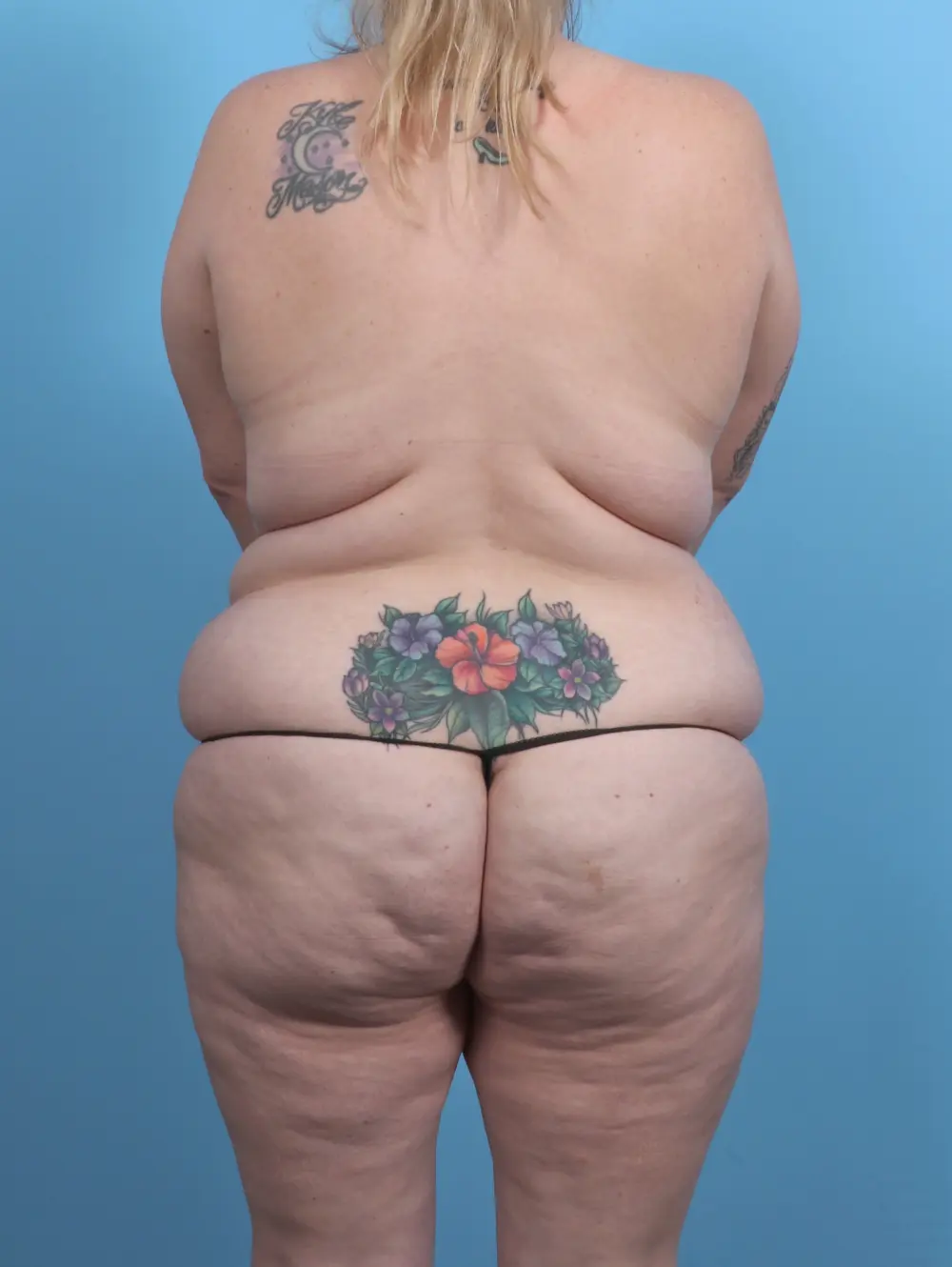 Tummy Tuck Patient Photo - Case 51199 - before view-3