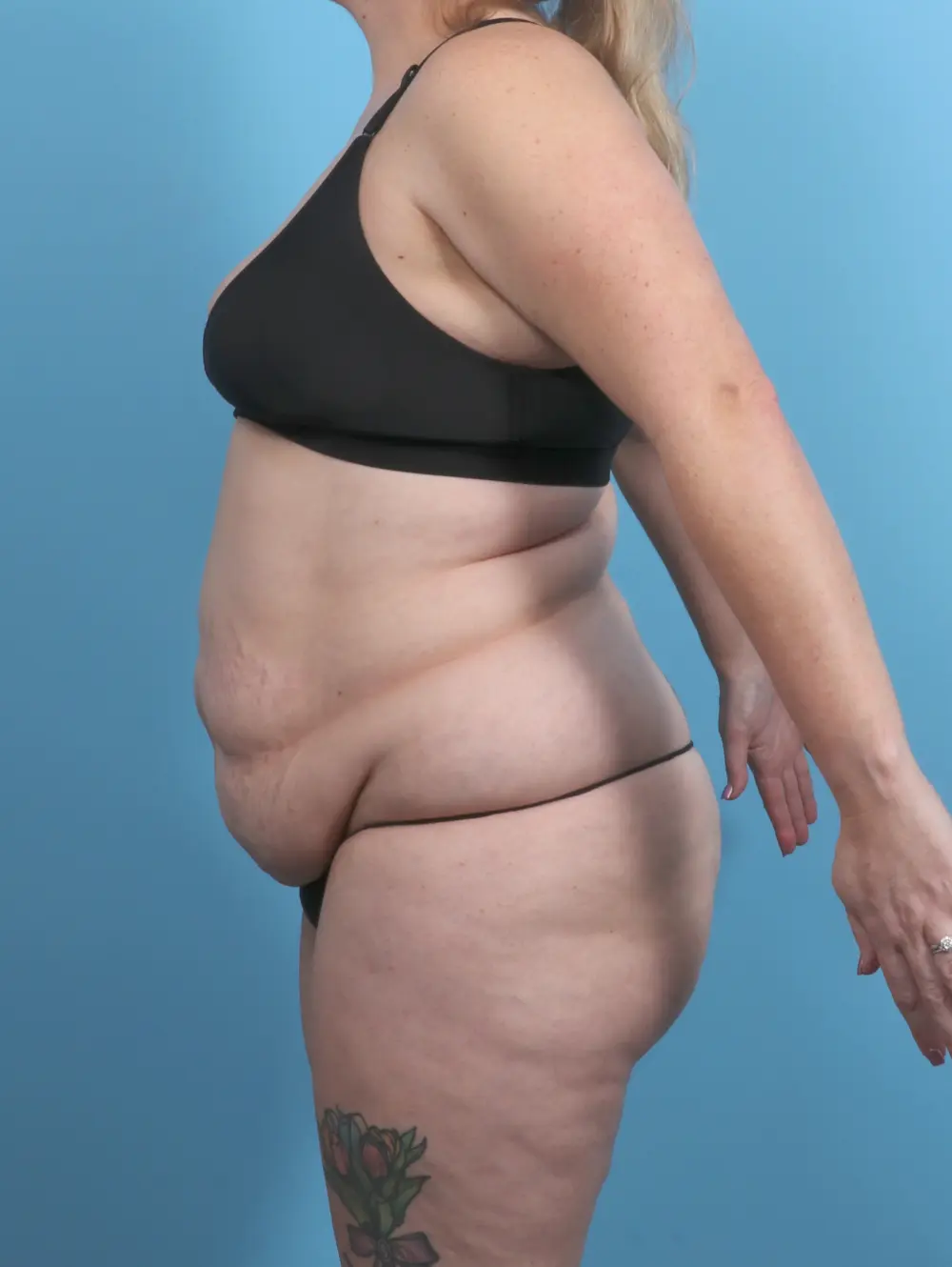Tummy Tuck Patient Photo - Case 51199 - before view-2