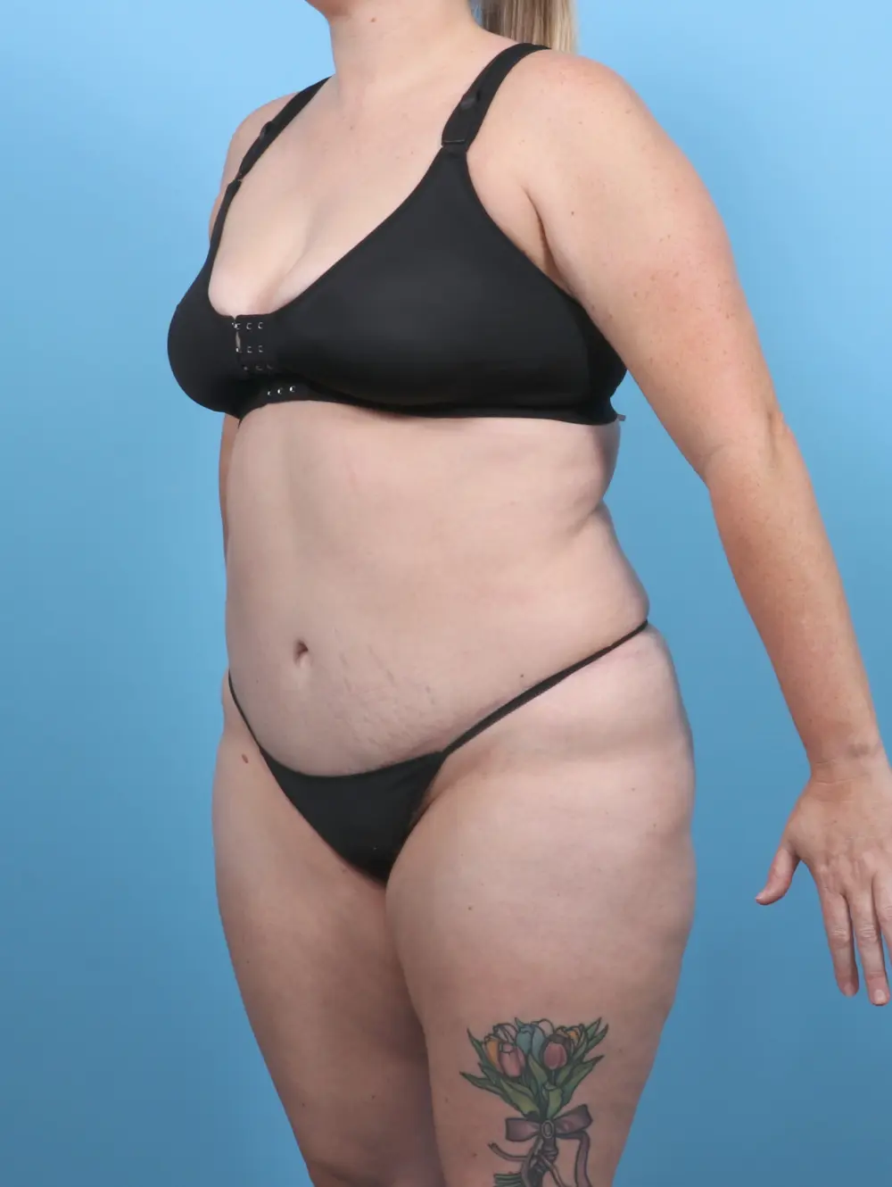 Tummy Tuck Patient Photo - Case 51199 - after view-1