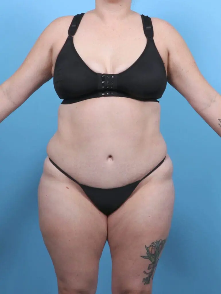 Tummy Tuck - Case 51199 - After