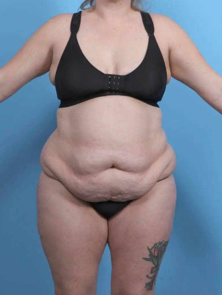 Tummy Tuck - Case 51199 - Before