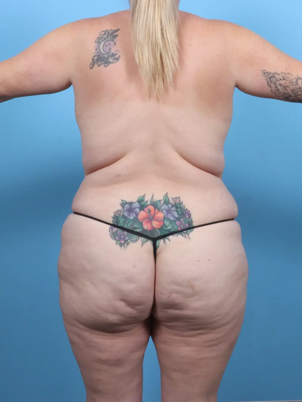 Tummy Tuck Patient Photo - Case 51199 - after view-3