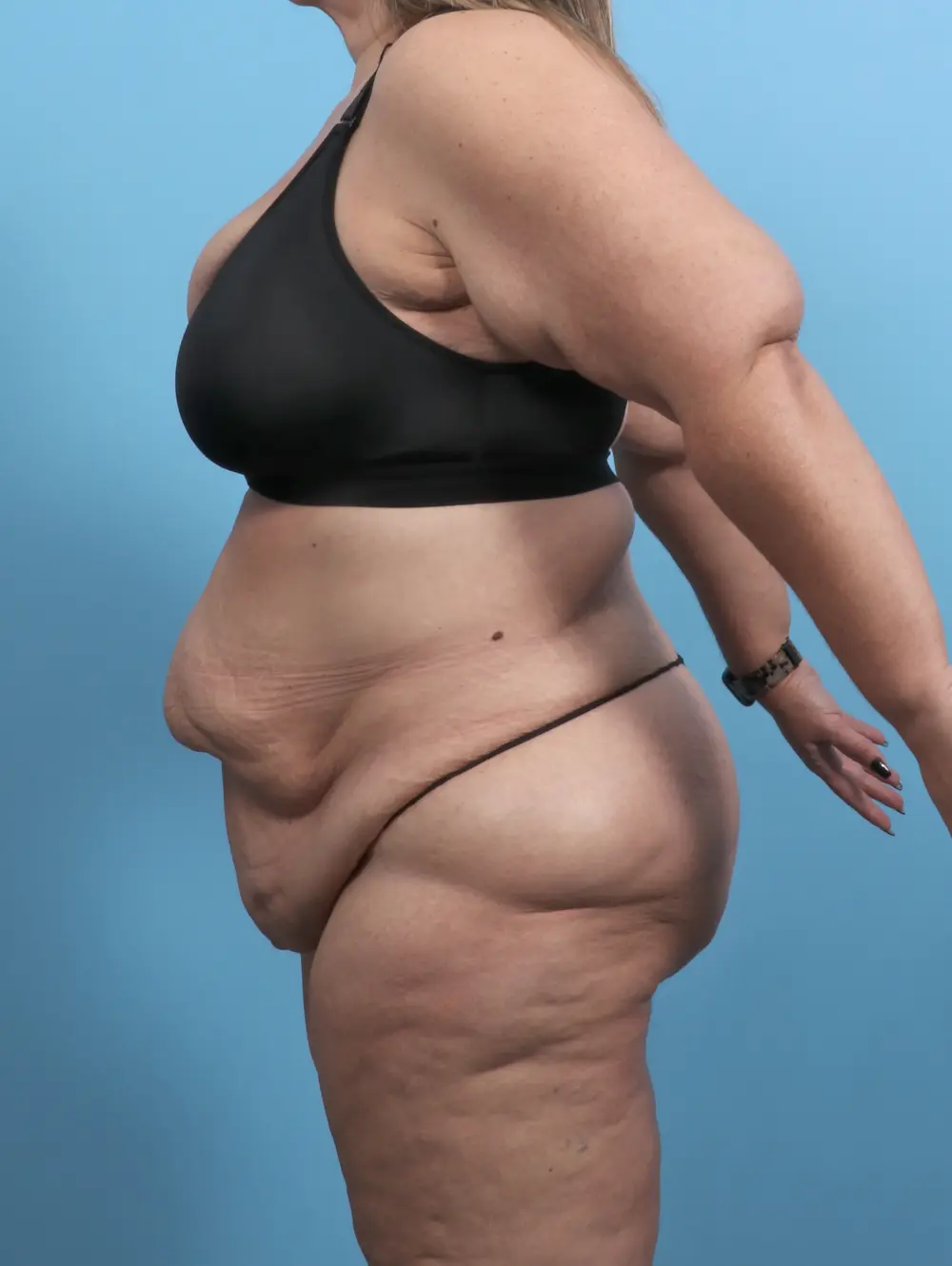 Tummy Tuck Patient Photo - Case 51209 - before view-2