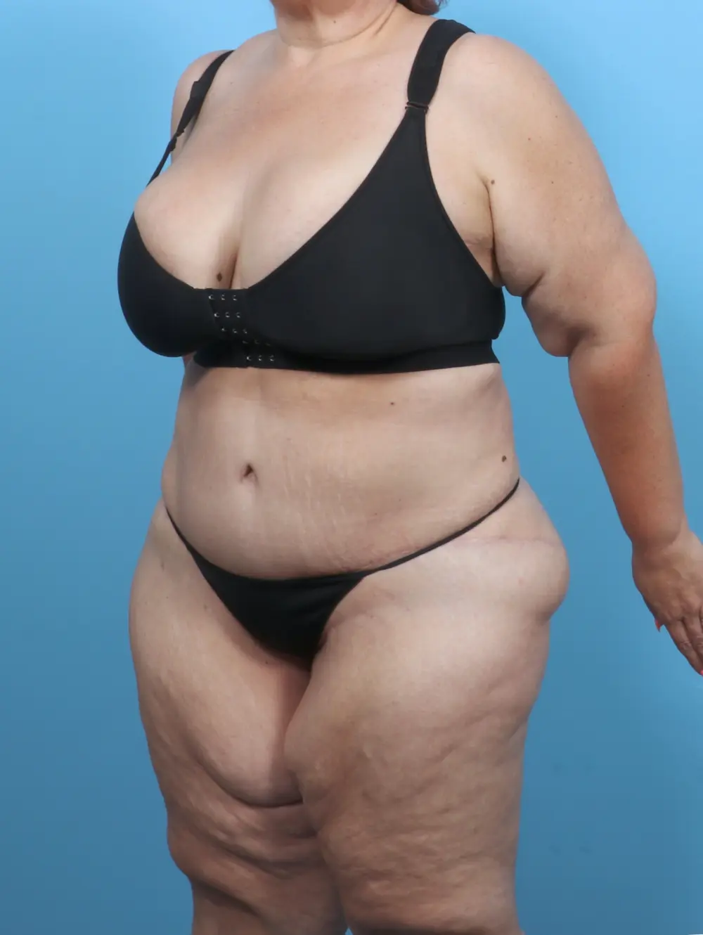 Tummy Tuck Patient Photo - Case 51209 - after view-1