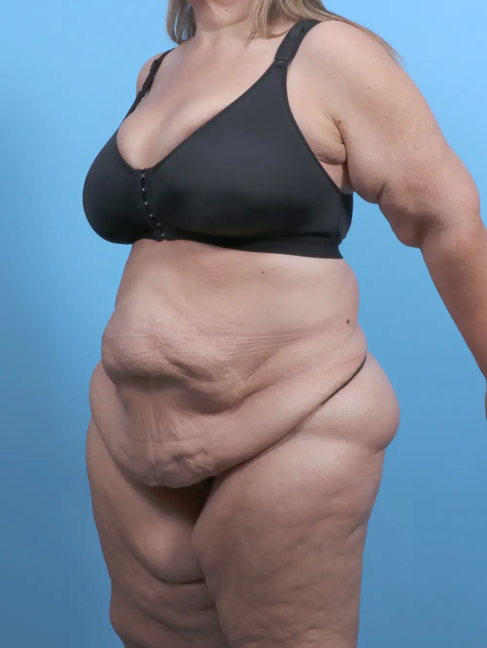 Tummy Tuck Patient Photo - Case 51209 - before view-1