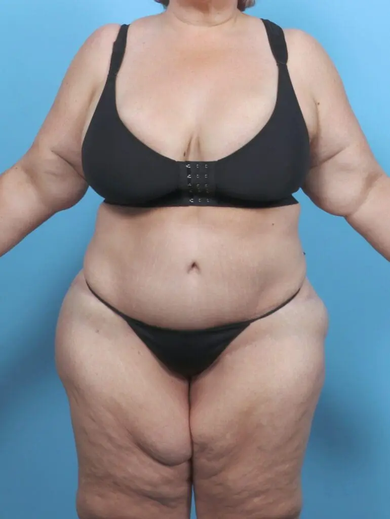 Tummy Tuck - Case 51209 - After