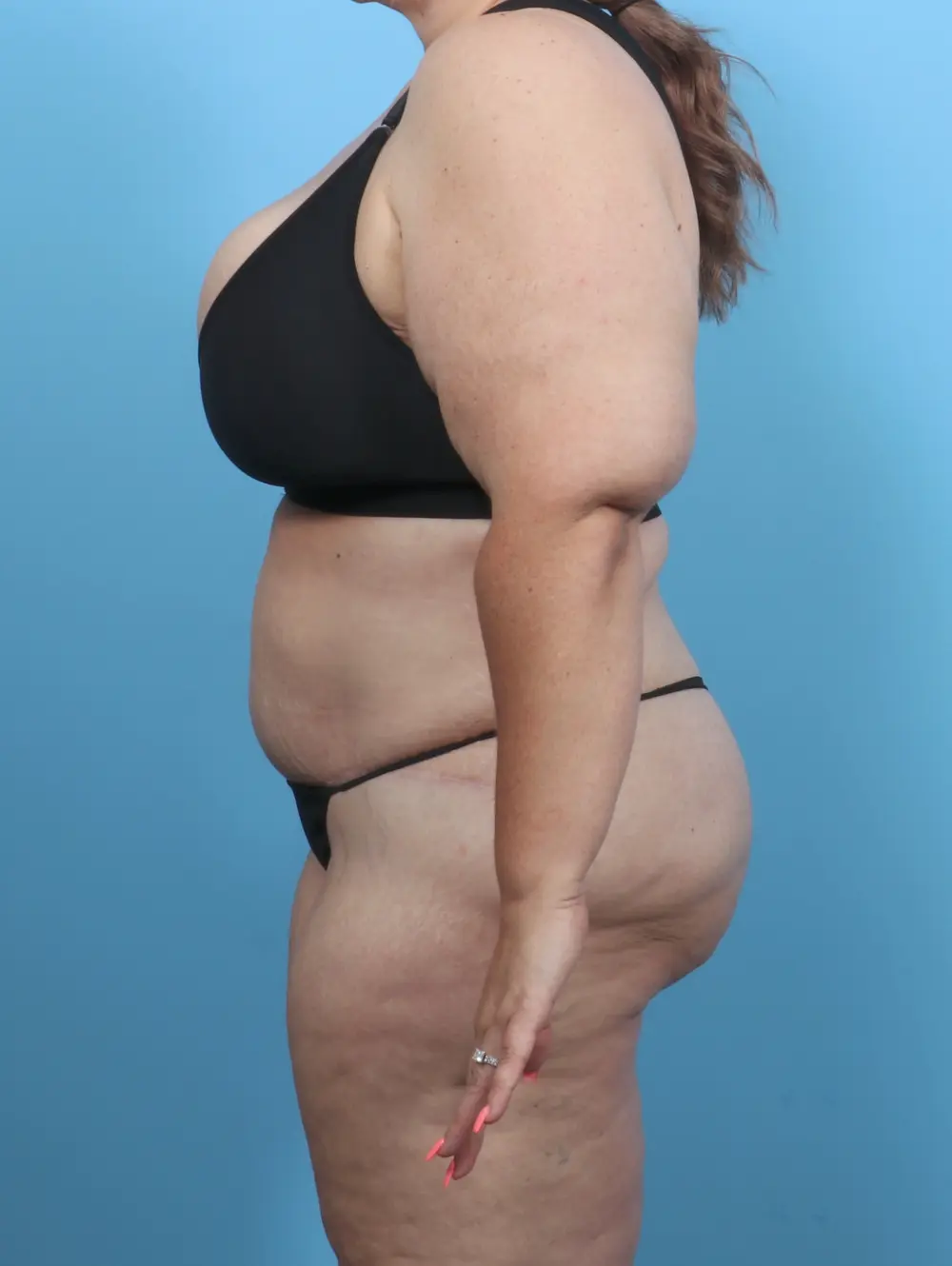 Tummy Tuck Patient Photo - Case 51209 - after view-2