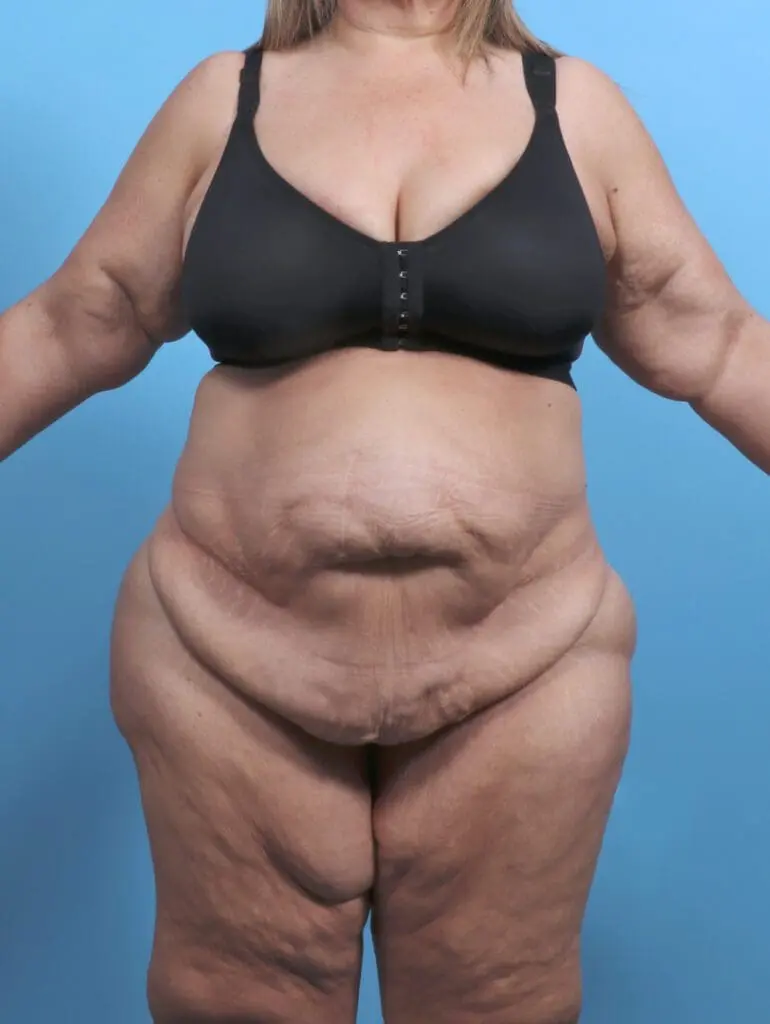 Tummy Tuck - Case 51209 - Before