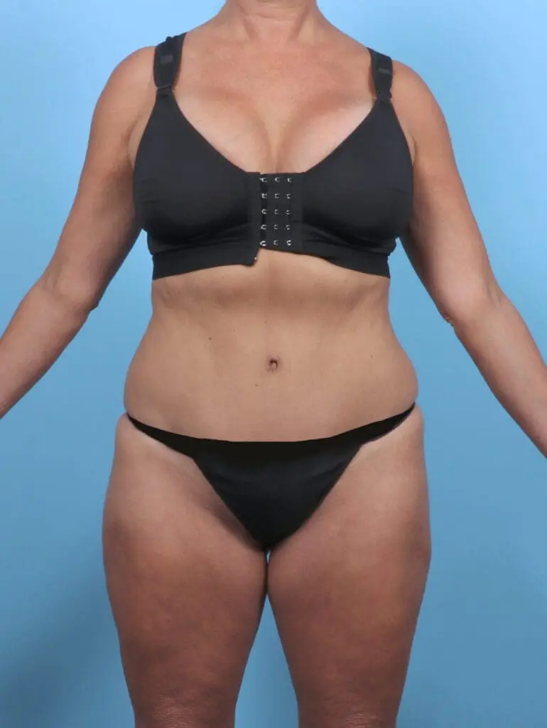 Tummy Tuck - Case 51217 - After