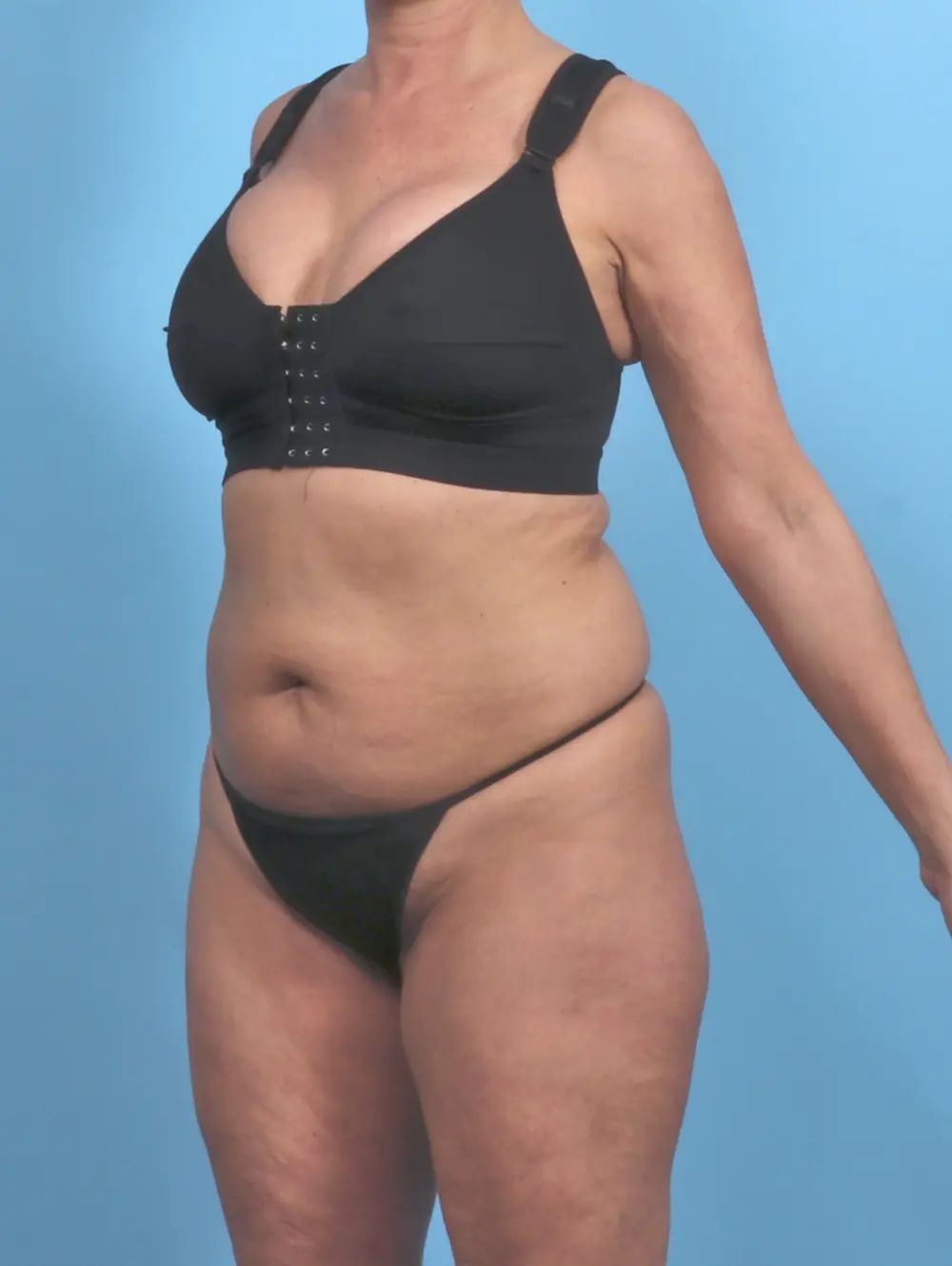 Tummy Tuck Patient Photo - Case 51217 - before view-1