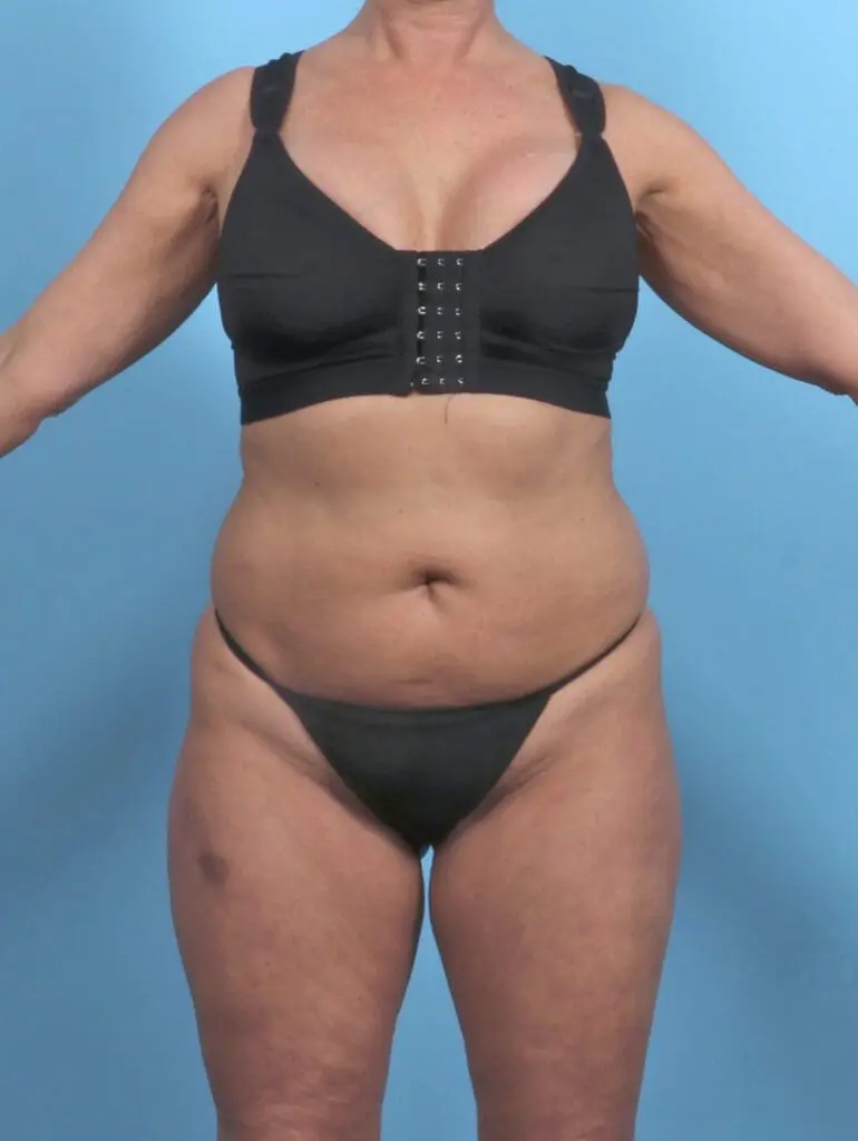 Tummy Tuck - Case 51217 - Before