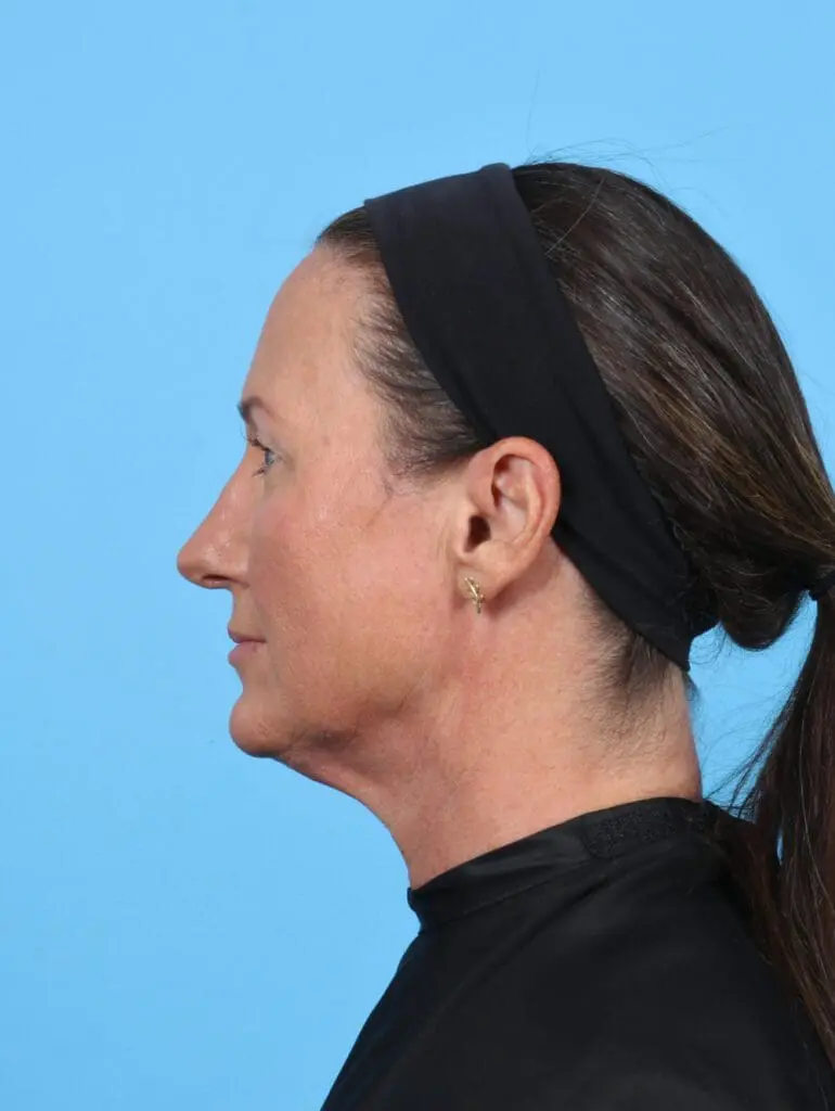 Rhinoplasty - Case 51250 - After