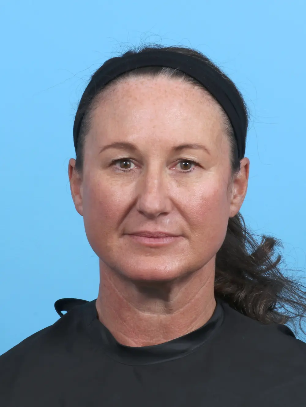 Rhinoplasty Patient Photo - Case 51250 - before view-2