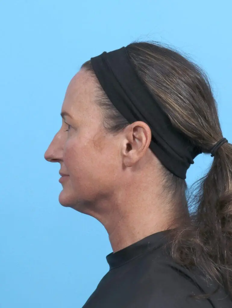 Rhinoplasty - Case 51250 - Before
