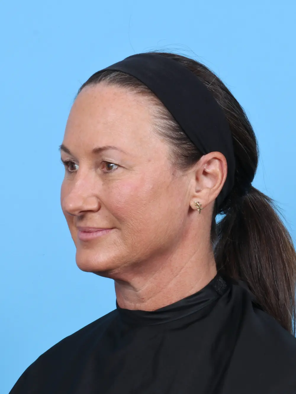 Rhinoplasty Patient Photo - Case 51250 - after view-1