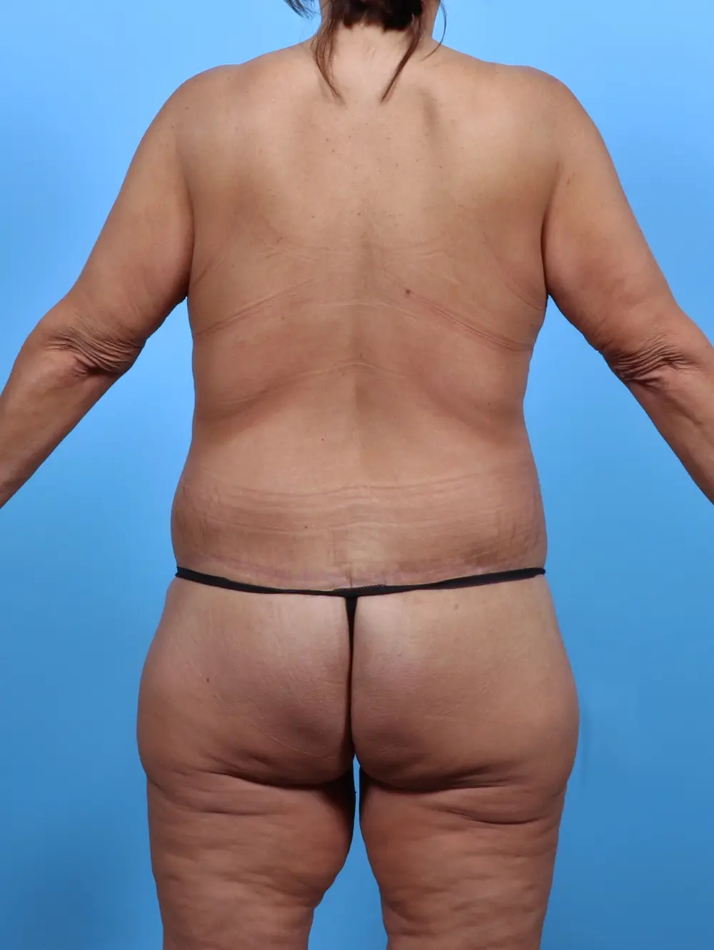 Body Lift Patient Photo - Case 51252 - after view-3