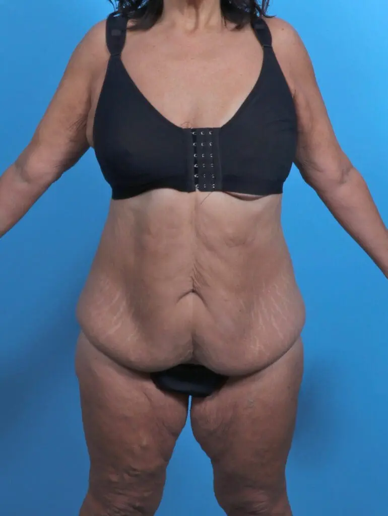 Body Lift - Case 51252 - Before