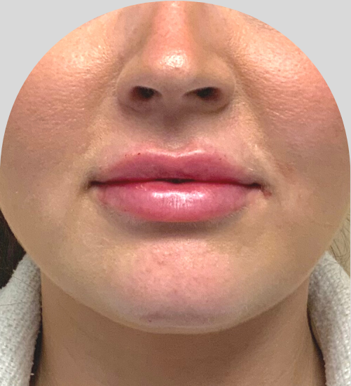 Lip Fillers - Case 51263 - After