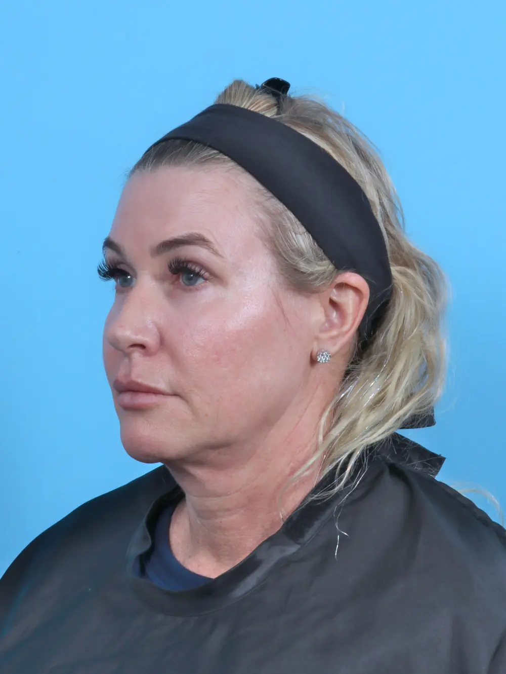 Eyelid Surgery Patient Photo - Case 51312 - before view-1