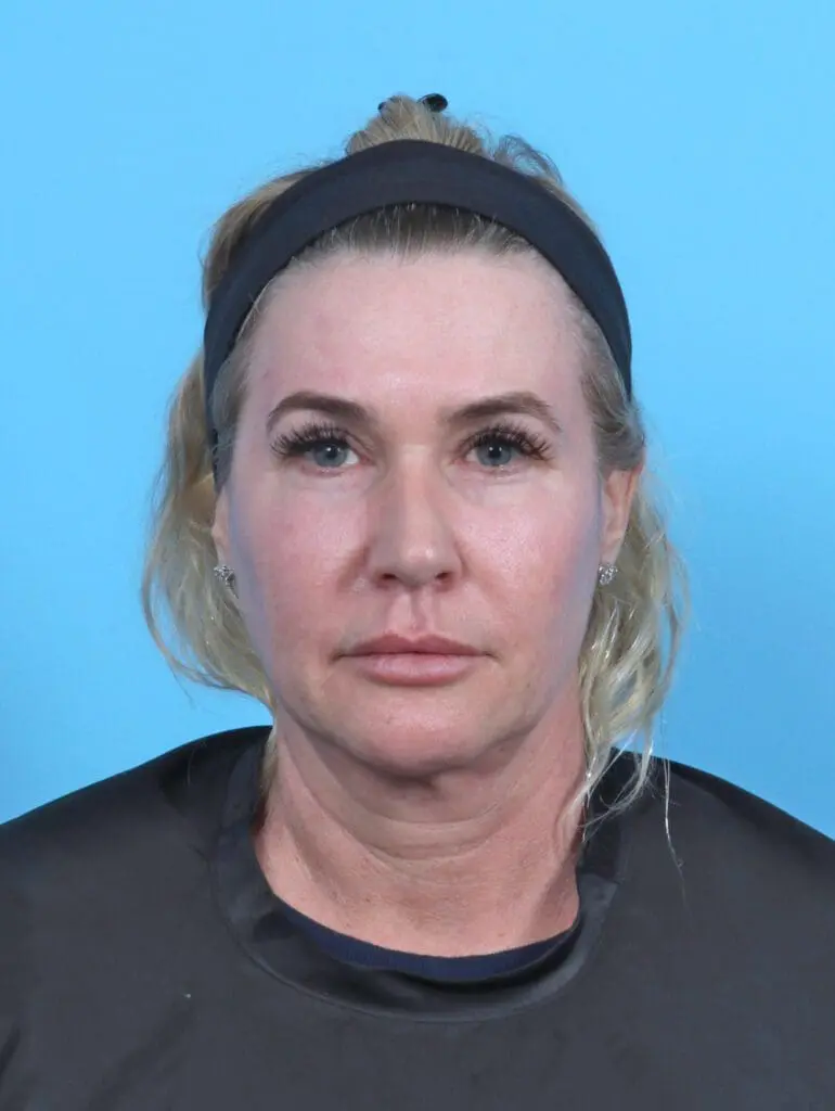 Eyelid Surgery - Case 51312 - Before