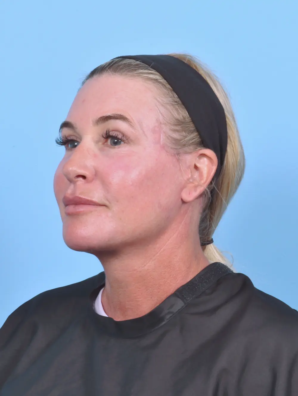 Eyelid Surgery Patient Photo - Case 51312 - after view-1