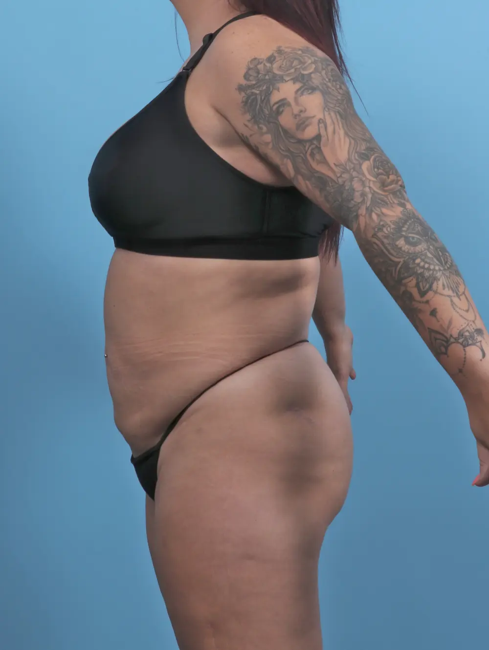 Tummy Tuck Patient Photo - Case 51326 - before view-2
