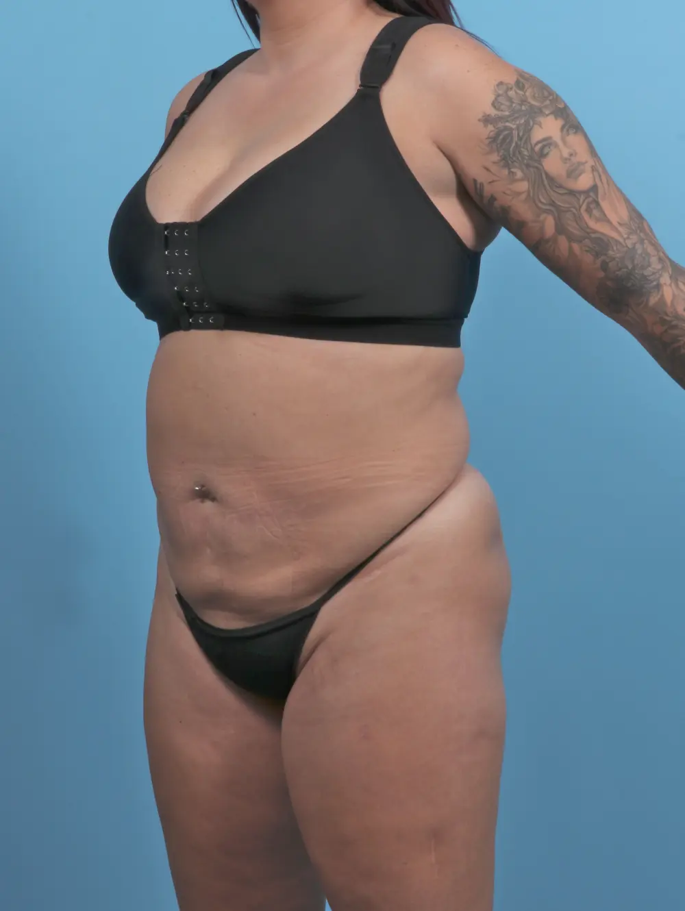 Tummy Tuck Patient Photo - Case 51326 - before view-1