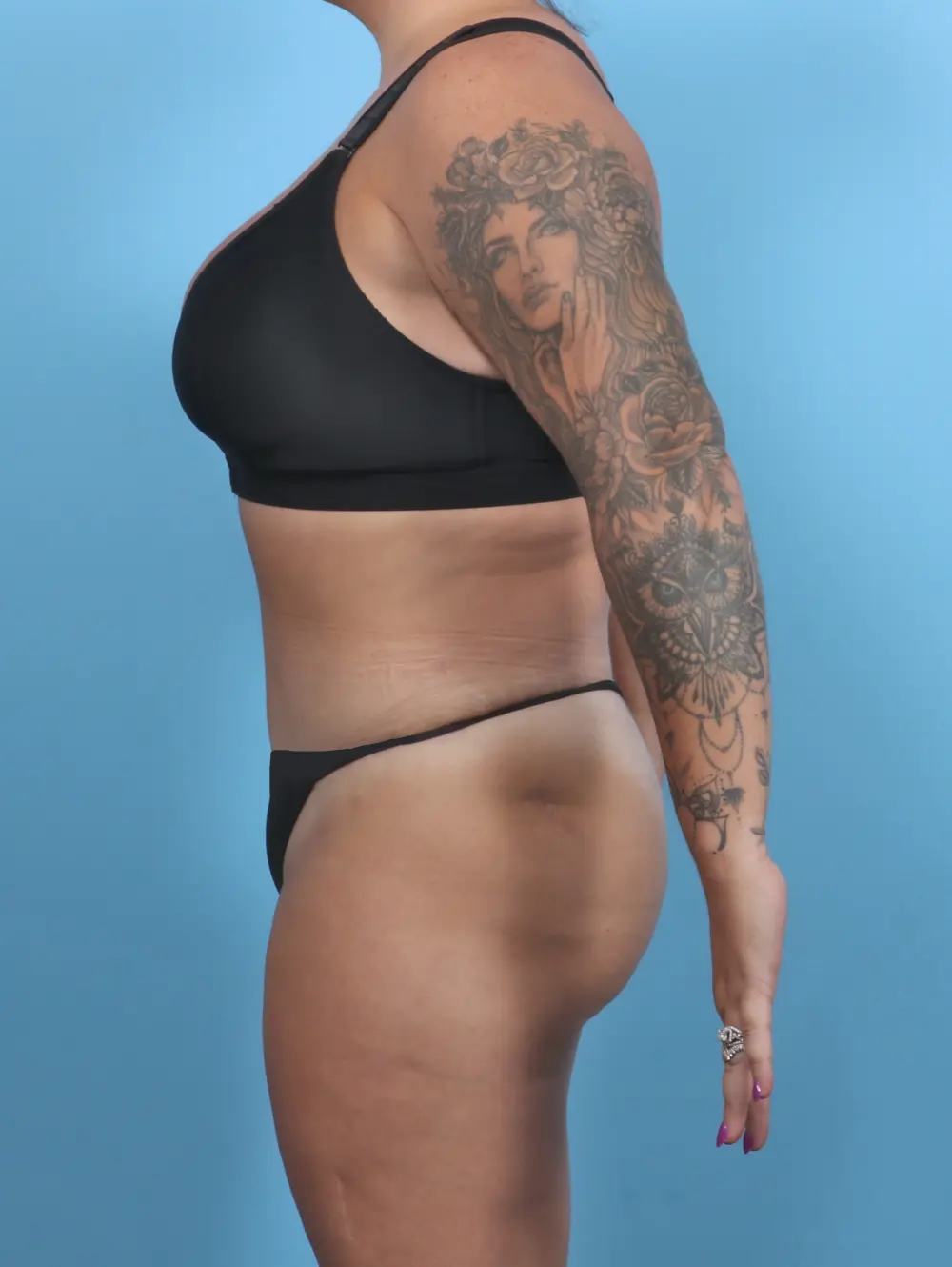 Tummy Tuck Patient Photo - Case 51326 - after view-2