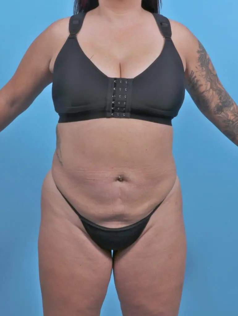 Tummy Tuck - Case 51326 - Before