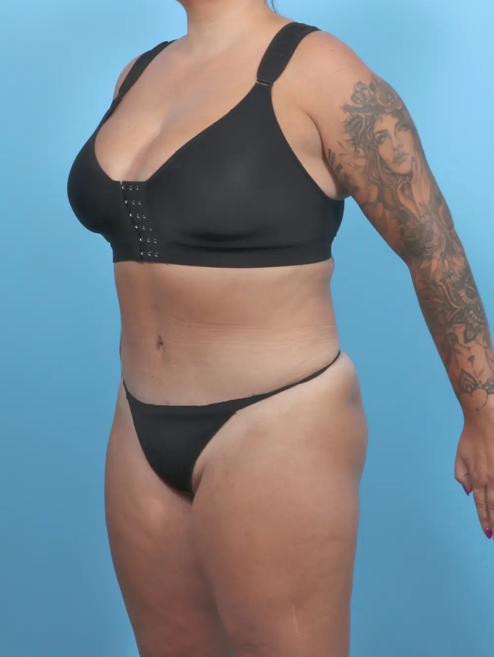 Tummy Tuck Patient Photo - Case 51326 - after view-1