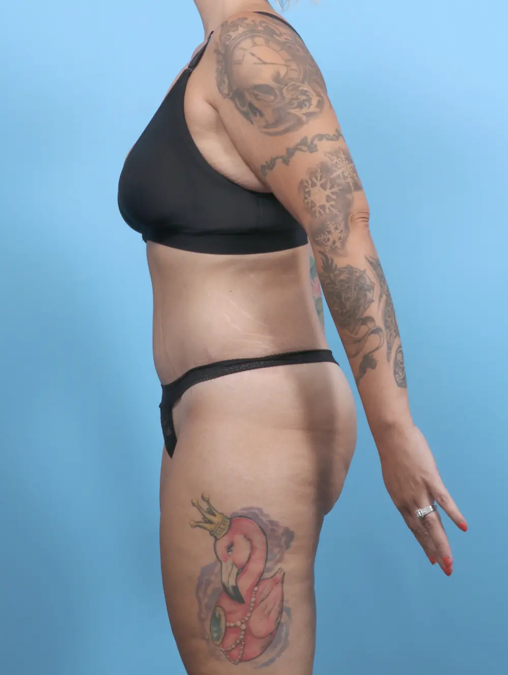 Tummy Tuck Patient Photo - Case 51345 - after view-2