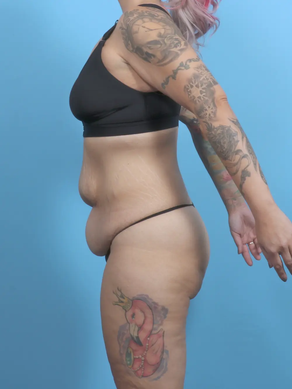 Tummy Tuck Patient Photo - Case 51345 - before view-2