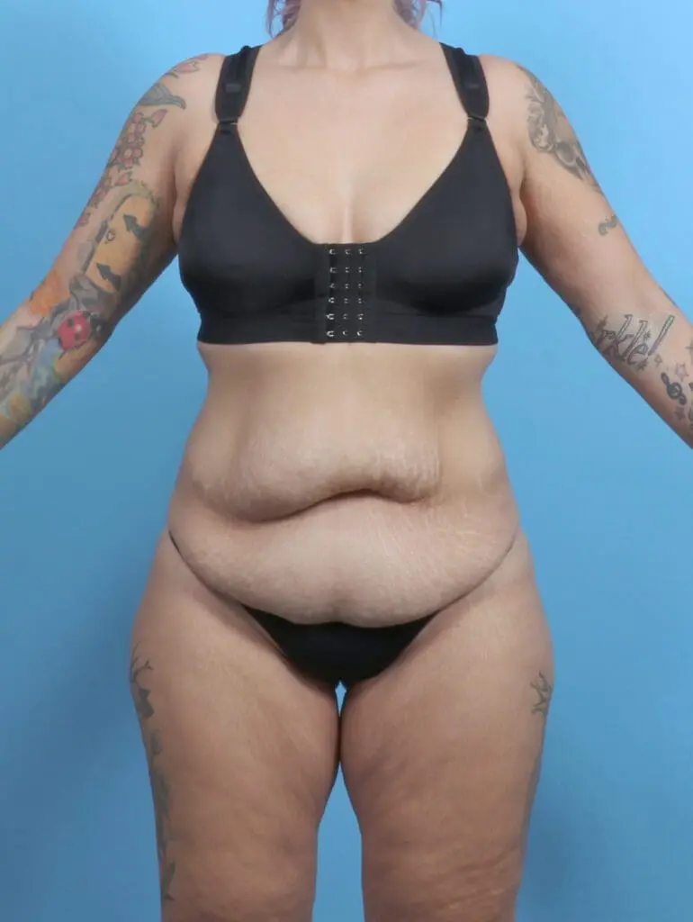 Tummy Tuck - Case 51345 - Before