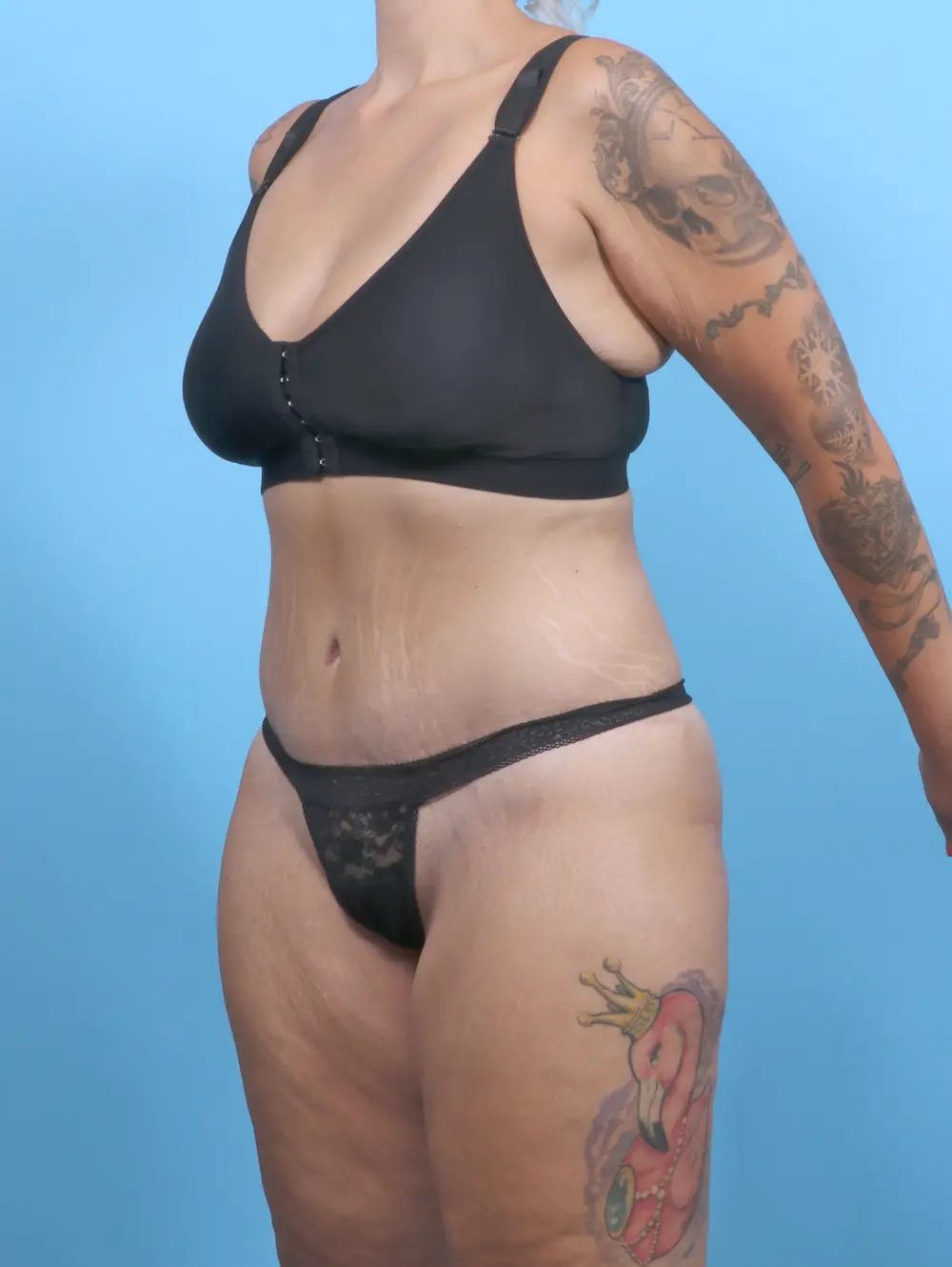 Tummy Tuck Patient Photo - Case 51345 - after view-1
